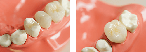 オールセラミック