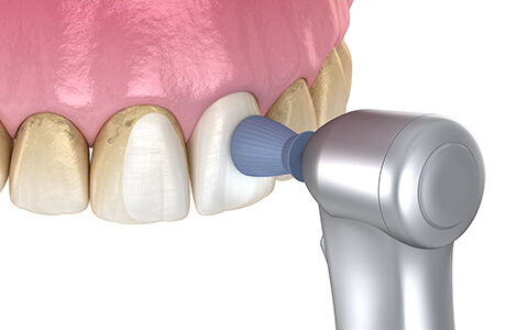 予防歯科 – 橋口歯科【厚木診療所】