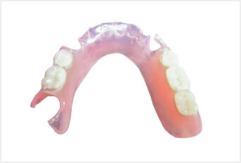 ノンクラスプデンチャー