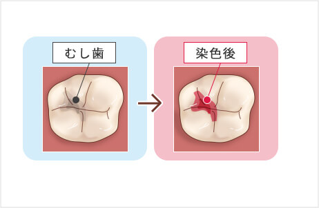 う蝕(虫歯)検知液