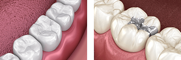 (C1～C2)軽度の虫歯治療