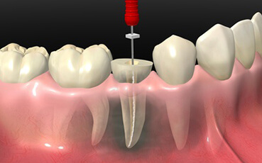 (C3)神経まで達した虫歯治療