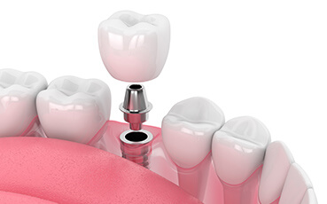 (C4)最重度の虫歯治療​