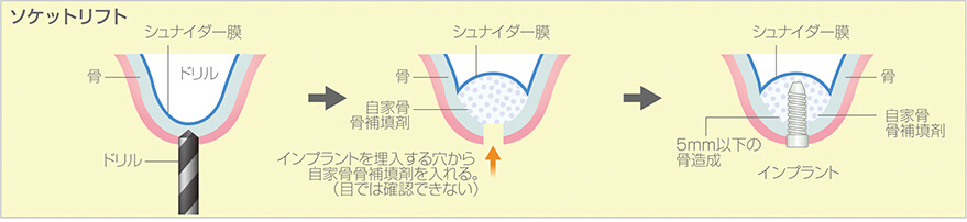 ソケットリフト