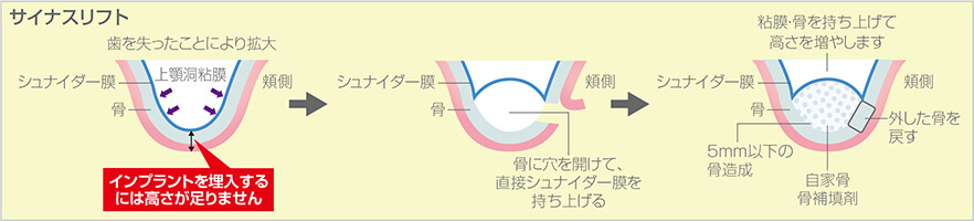 サイナスリフト​