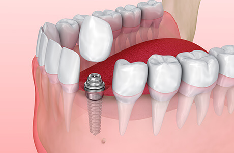 プロビジョナルレストレーション