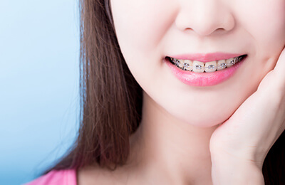 表側矯正(唇側矯正)