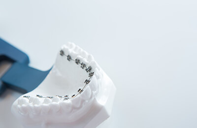 裏側矯正(舌側矯正)