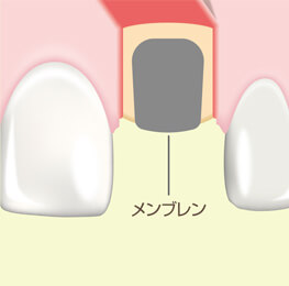 GBR(骨誘導再生)