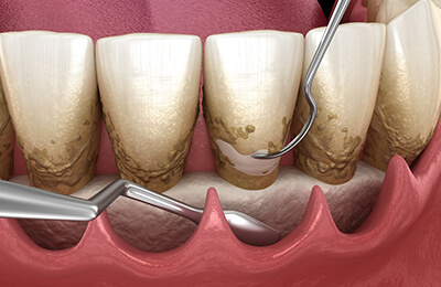 FOP(歯肉剥離掻爬術)