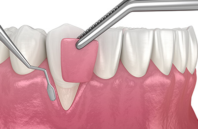 FGG(遊離歯肉移植術)