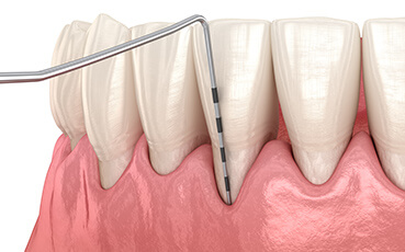 歯周ポケットの測定(プロービング)