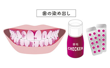 STEP1 歯垢の染め出し