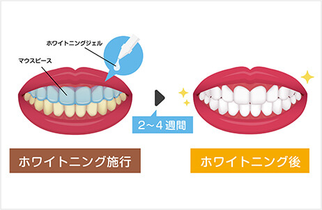 ホームケアの指導