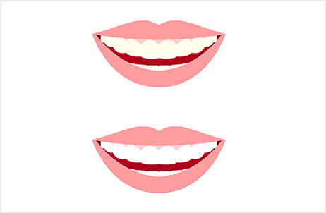 ペリオフィールを歯肉へ注入