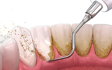 歯周基本治療​